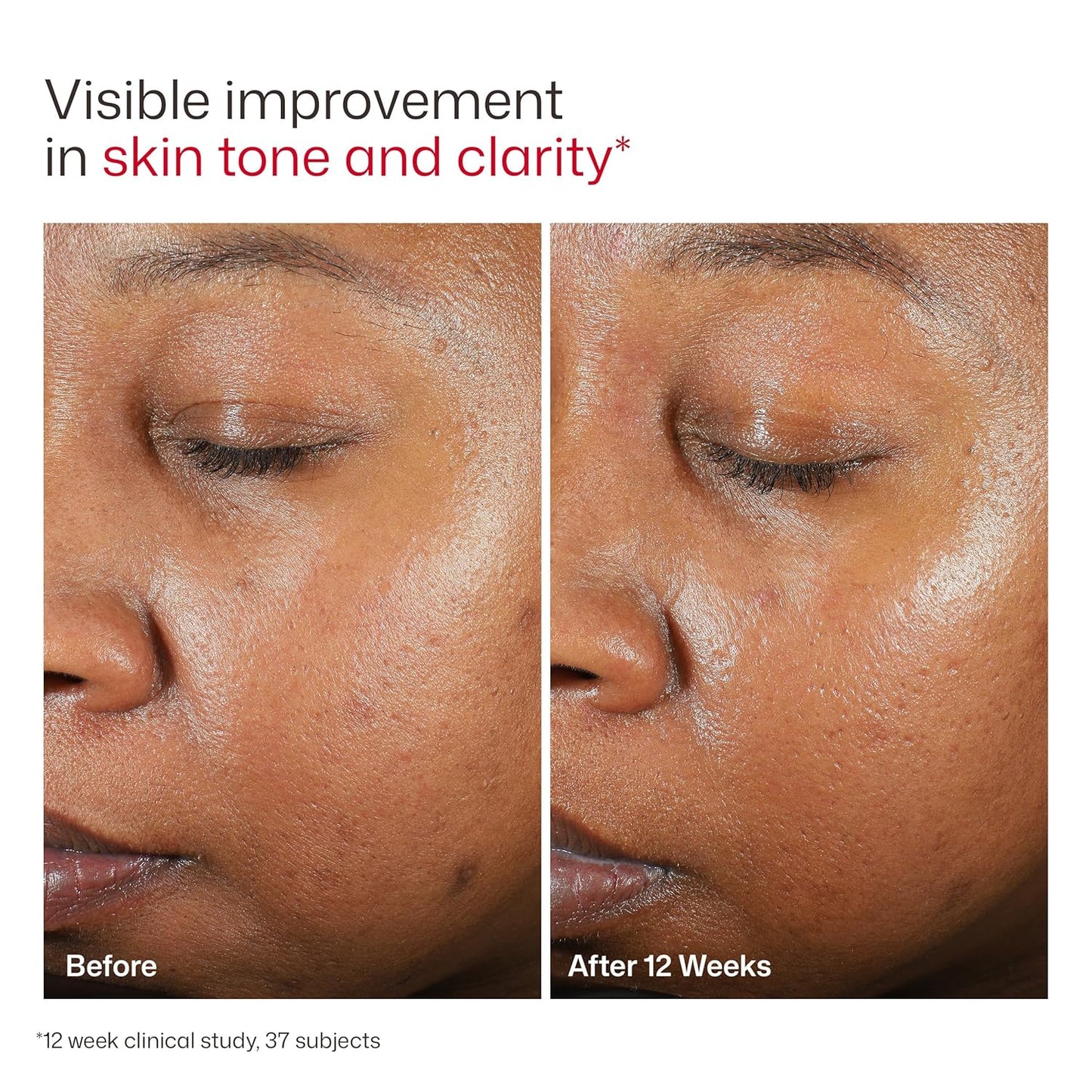EltaMD UV Clear Facial Sunscreen SPF 46 — Oil-Free Zinc Oxide Formula, Dermatologist Recommended (Copy)