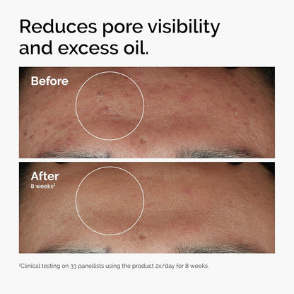The Ordinary Niacinamide 10% + Zinc 1% — Smoothing Serum for Blemish-Prone Skin