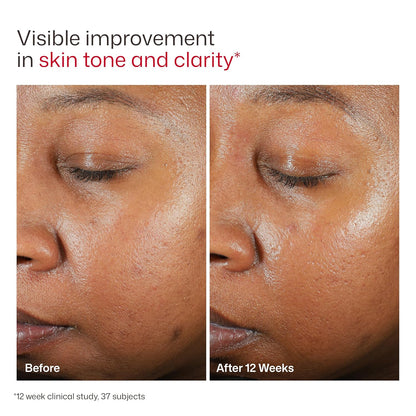 EltaMD UV Clear Facial Sunscreen SPF 46 — Oil-Free Zinc Oxide Formula, Dermatologist Recommended (Copy)